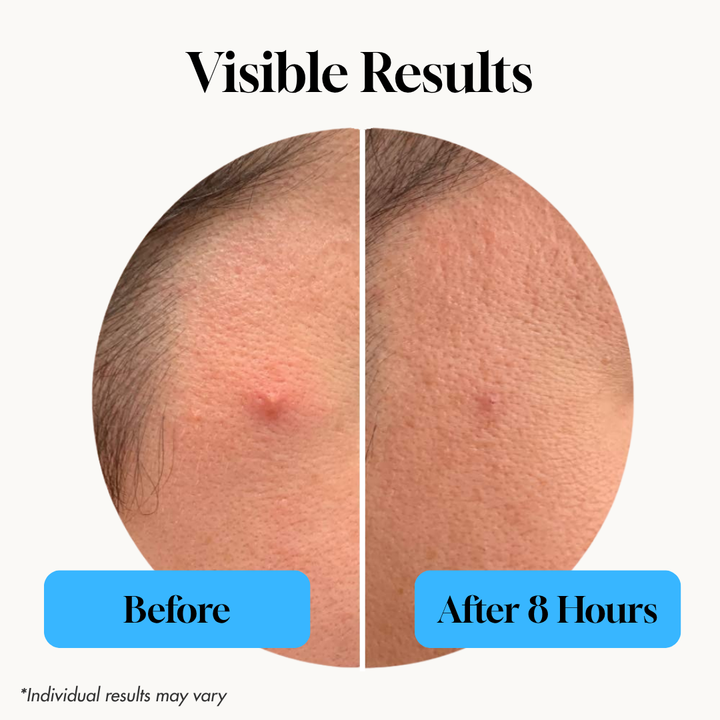 STIK Acne Rescue Kit: Visible results, before and after 8 hours