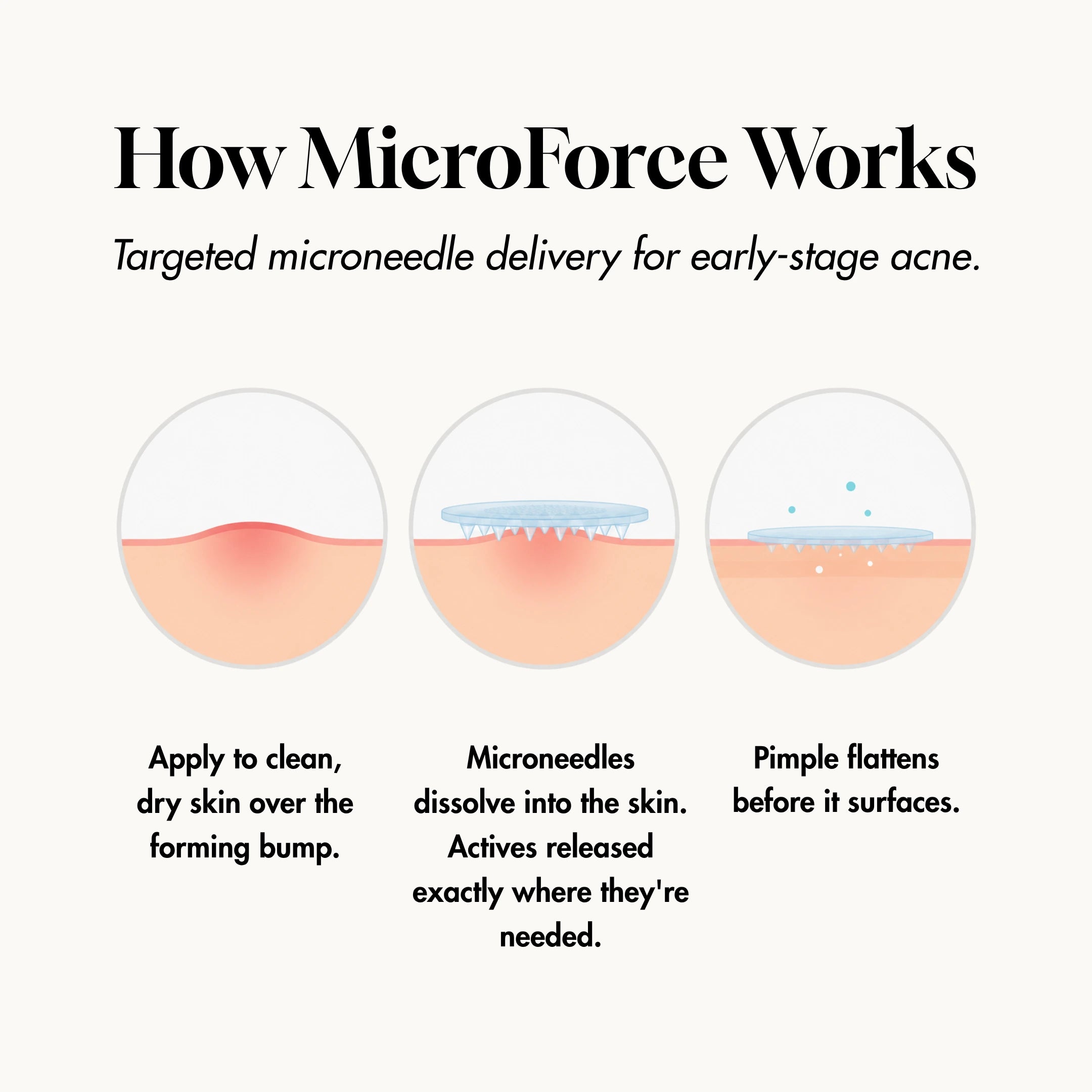 MicroForce for Early Acne