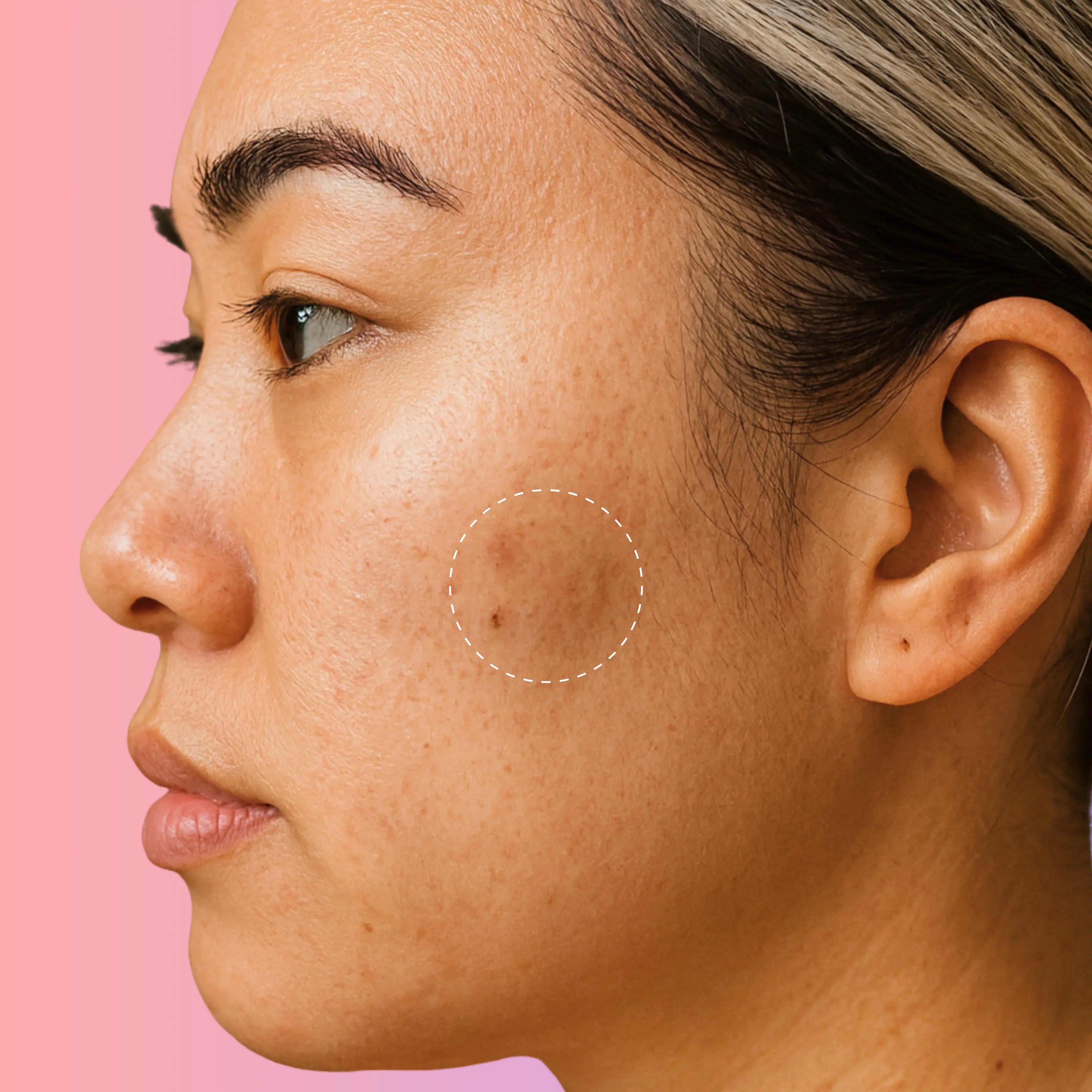 MicroForce for Dark Spots