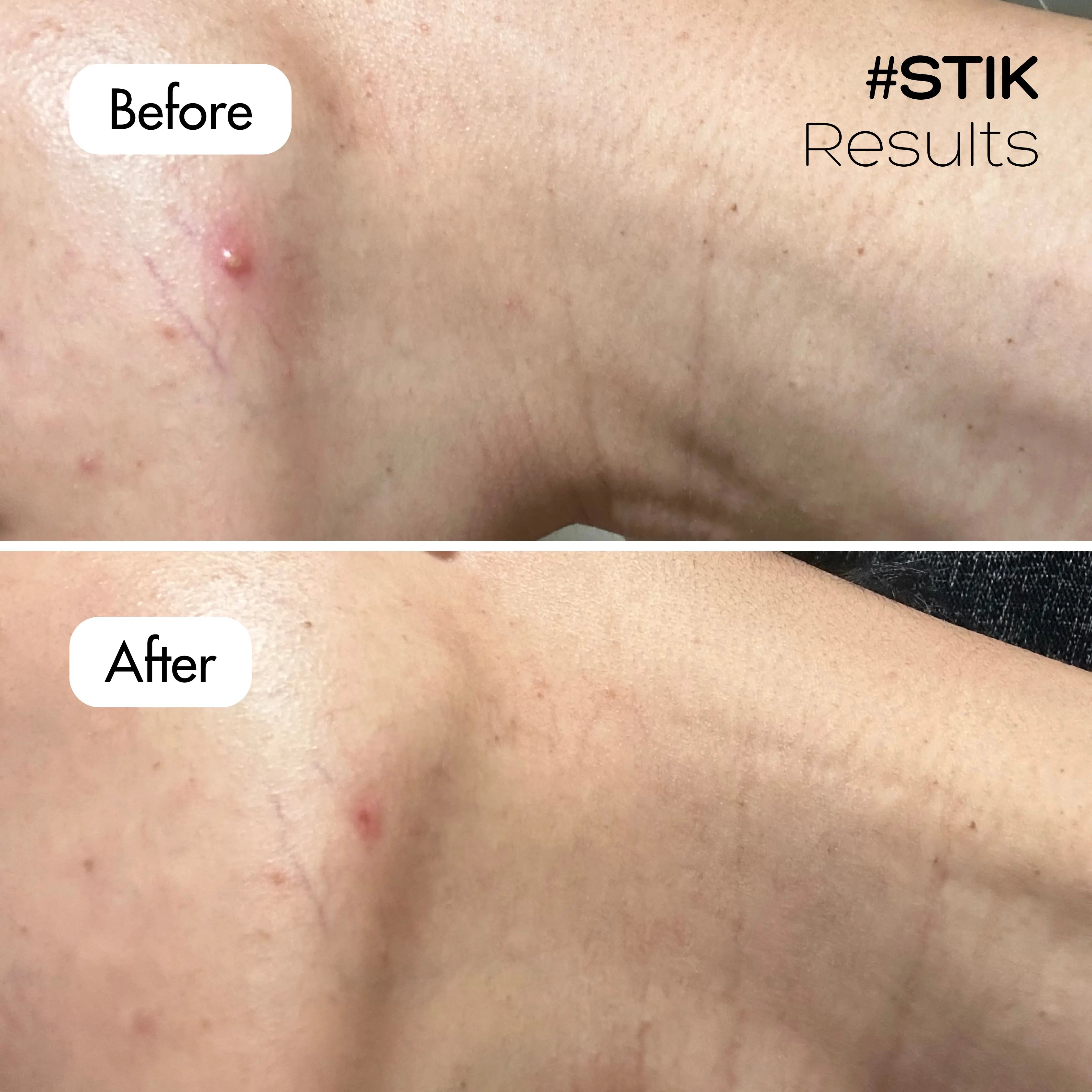 MicroForce for Whiteheads