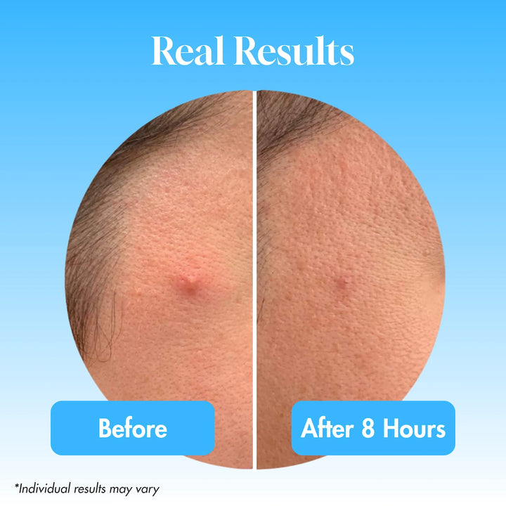 Acne Rescue Kit