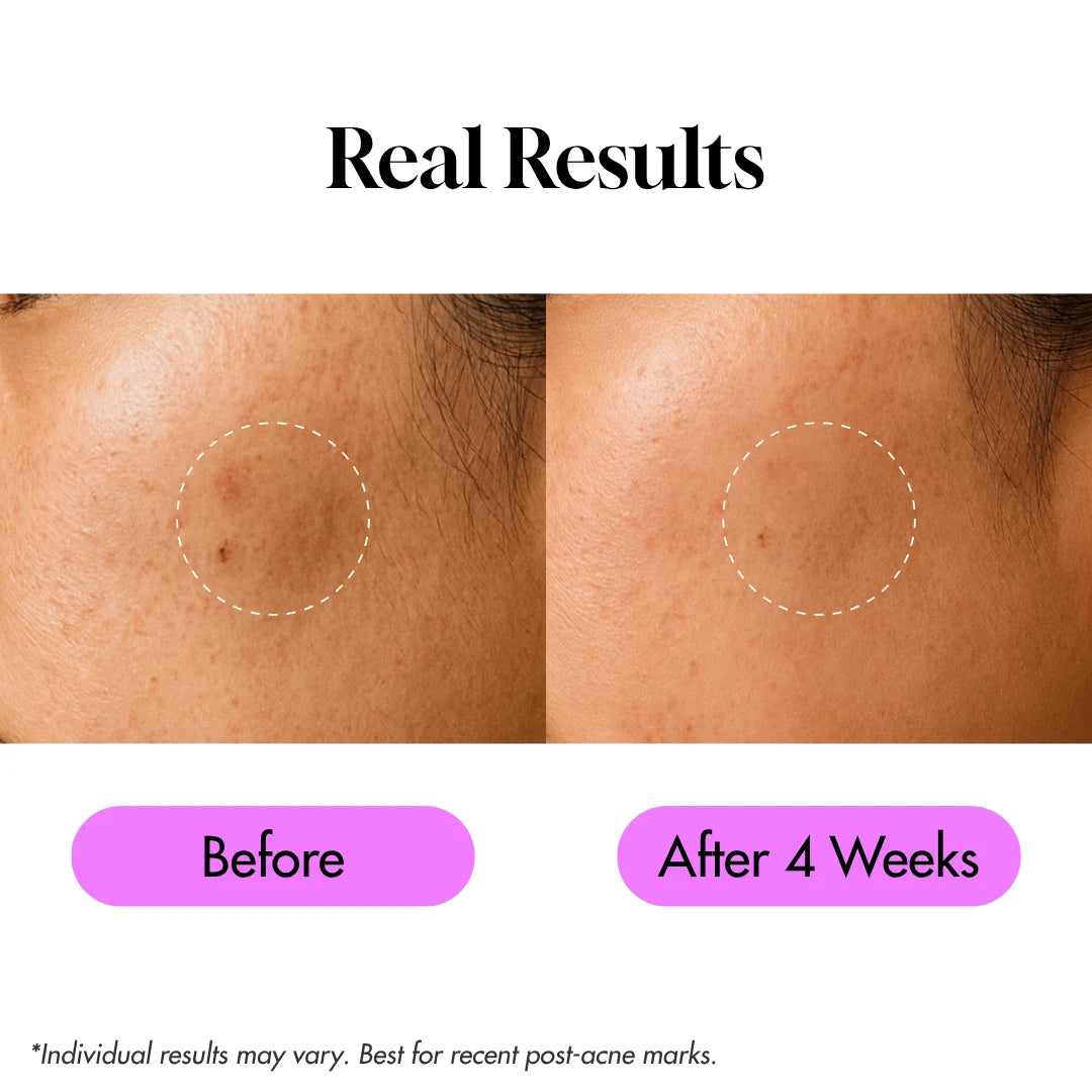 MicroForce for Dark Spots