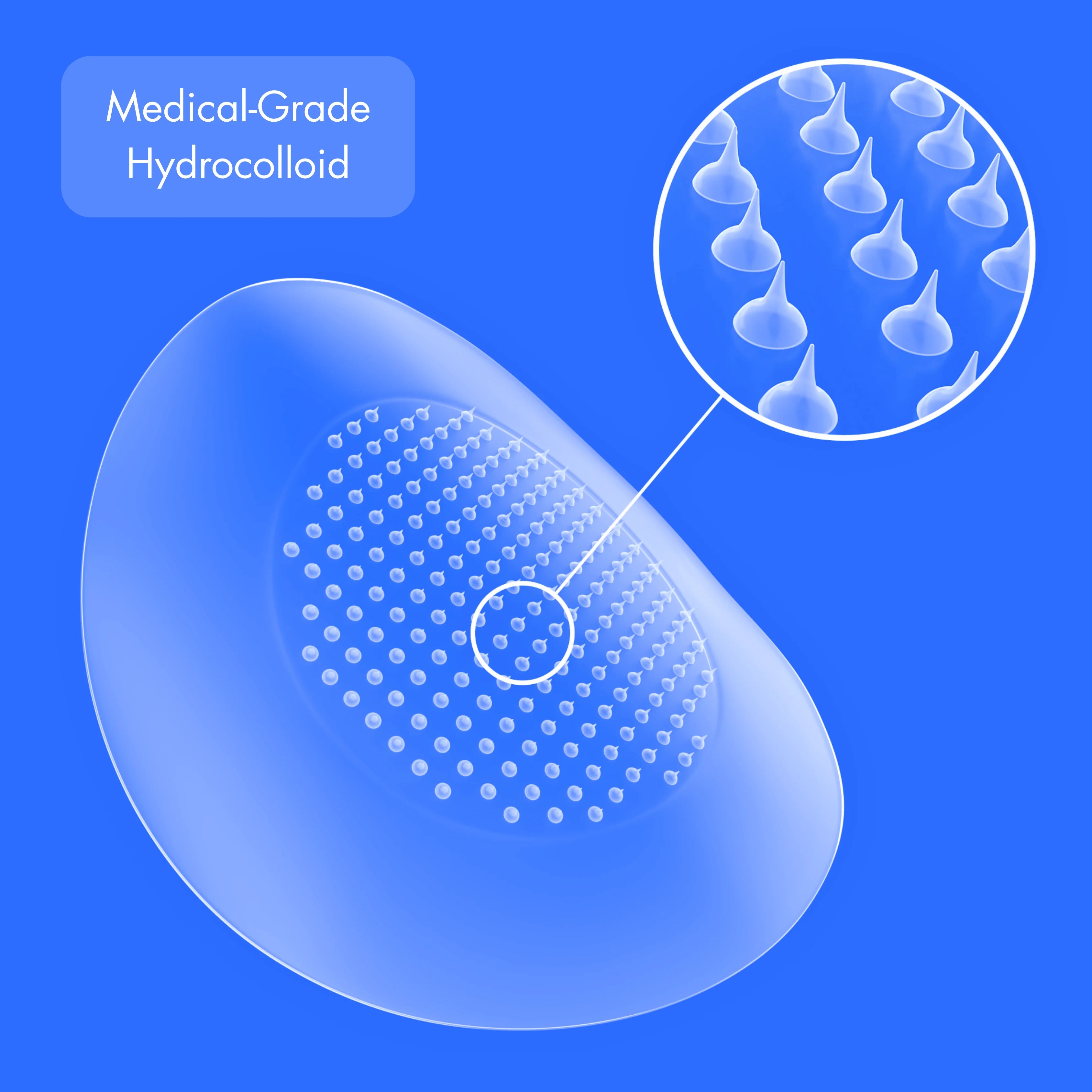 MicroForce for Whiteheads